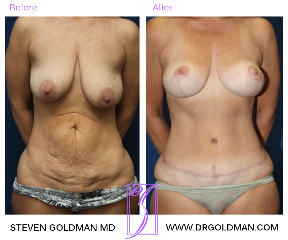 Mommy Makeover