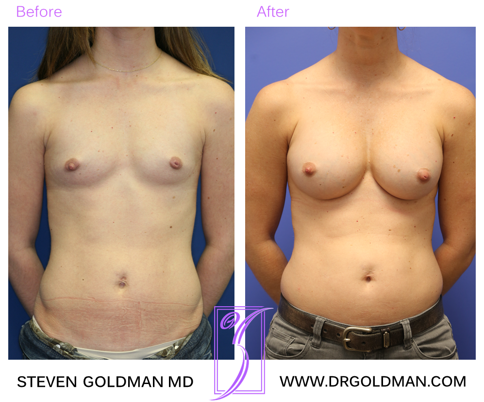 Breast Augmentation