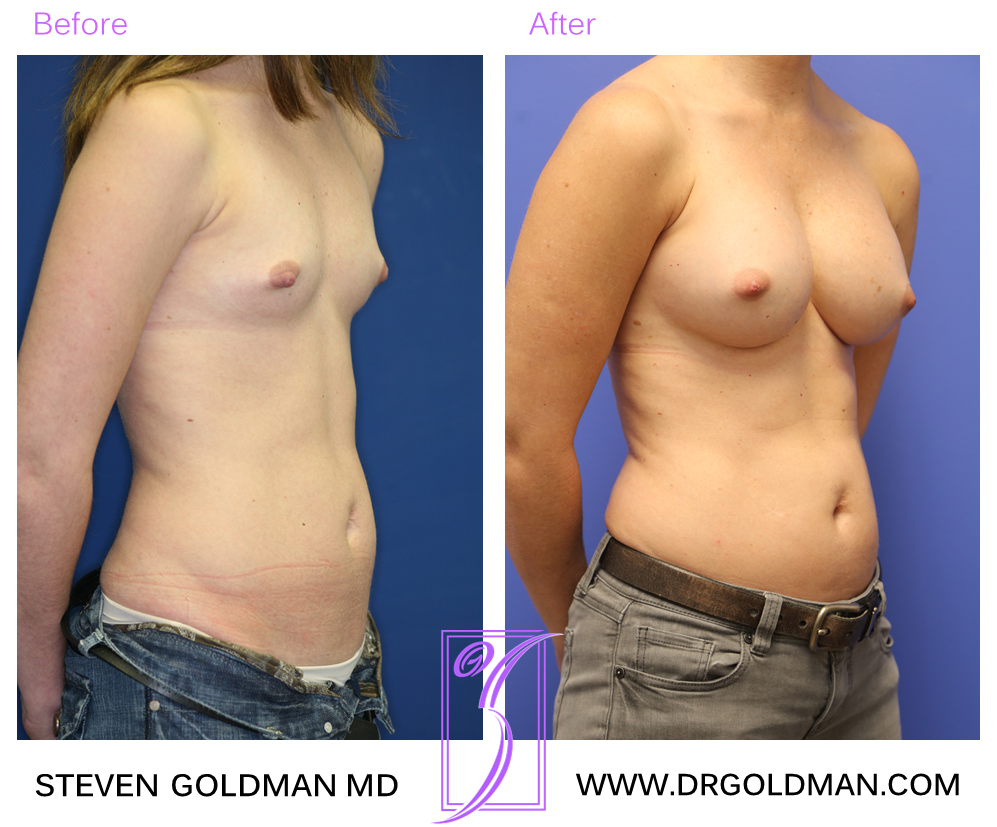 Breast Augmentation
