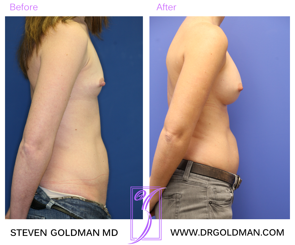 Breast Augmentation