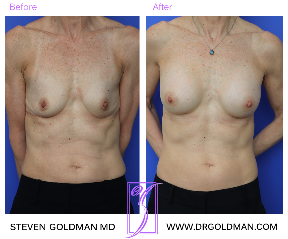 Breast Augmentation
