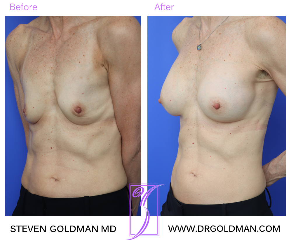 Breast Augmentation