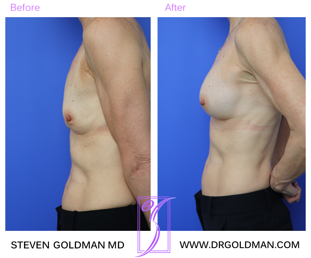 Breast Augmentation