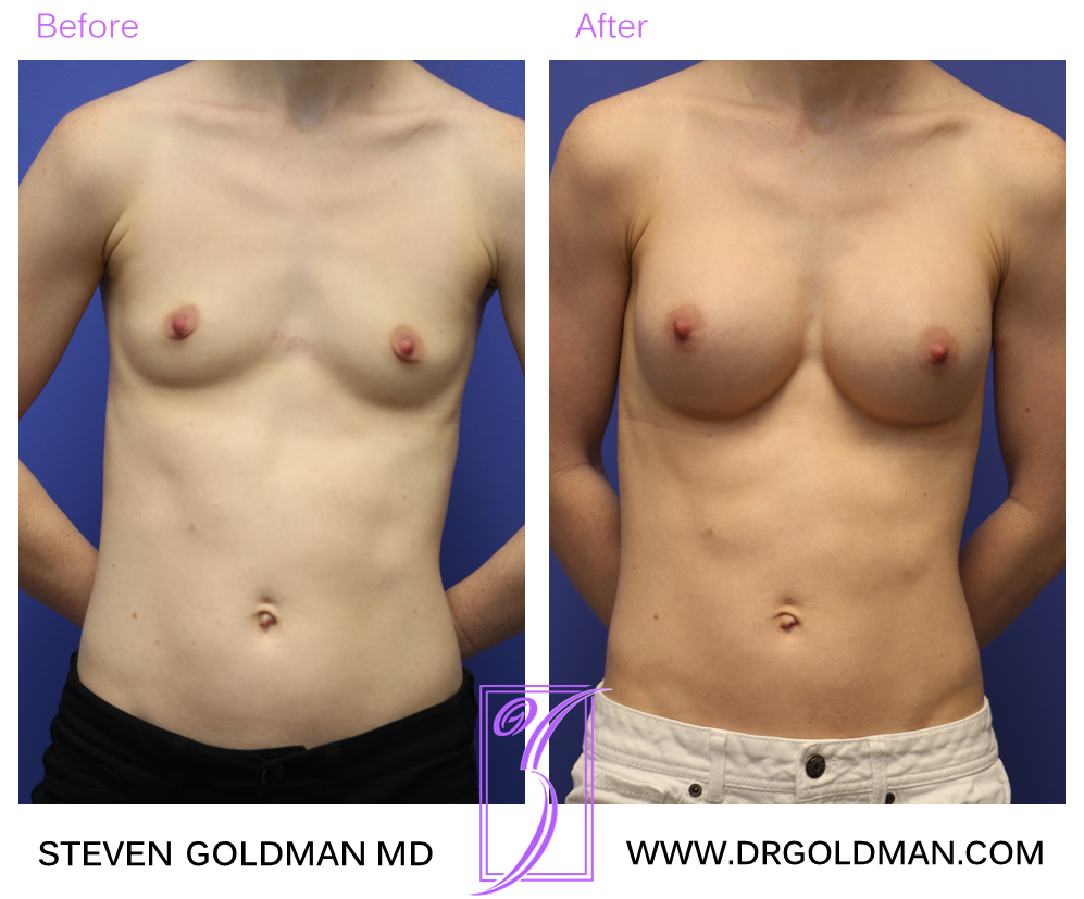 Breast Augmentation