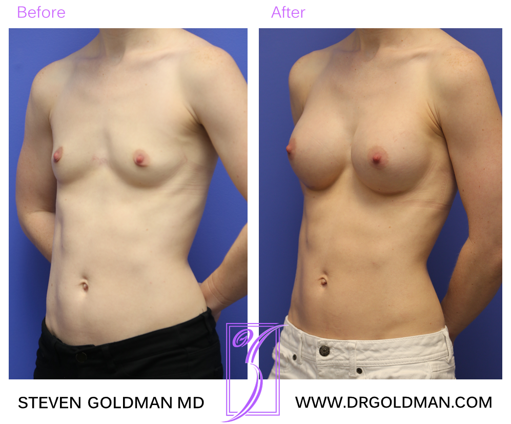 Breast Augmentation