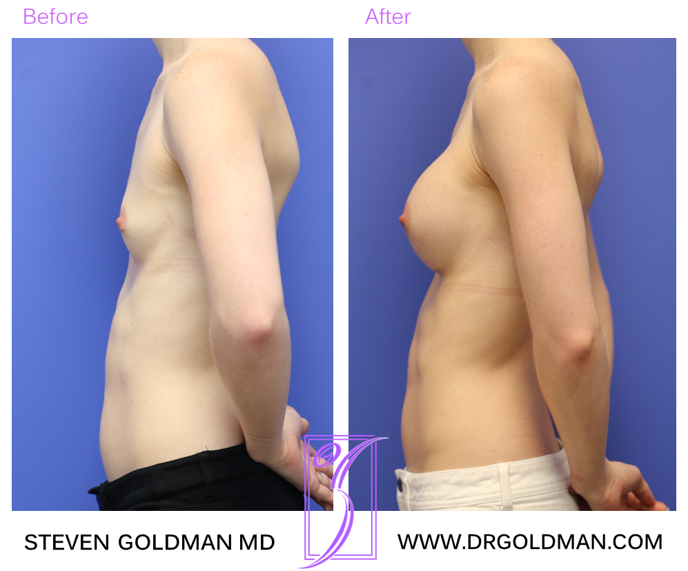 Breast Augmentation