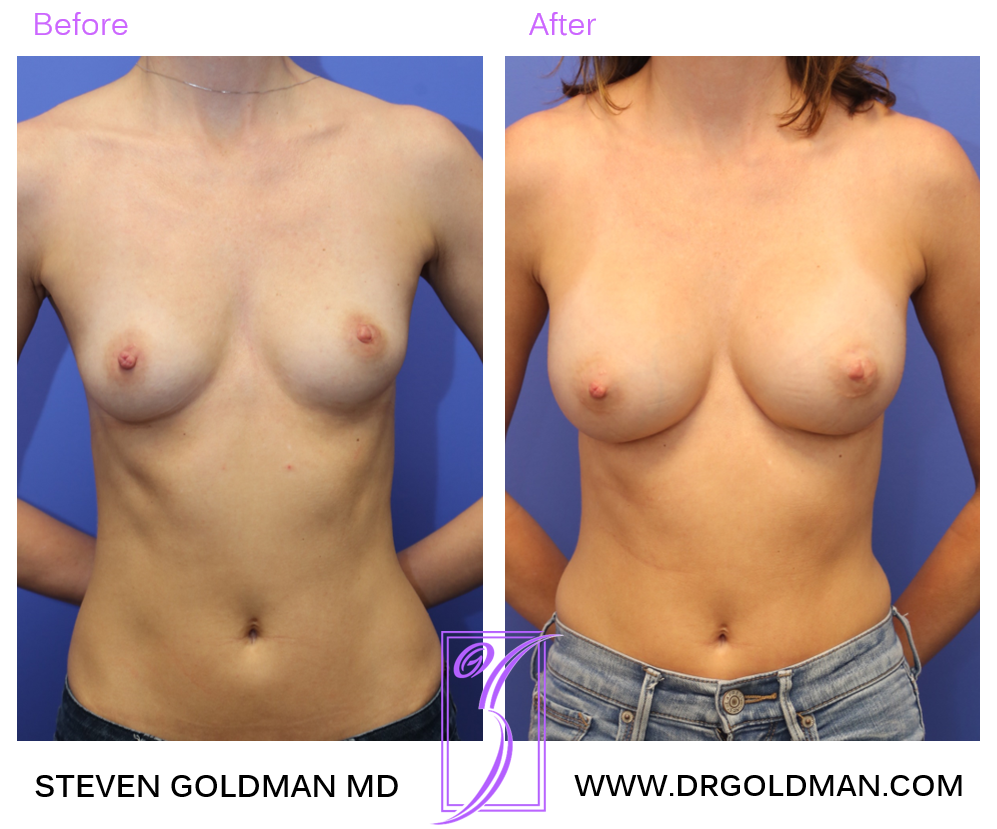 Breast Augmentation