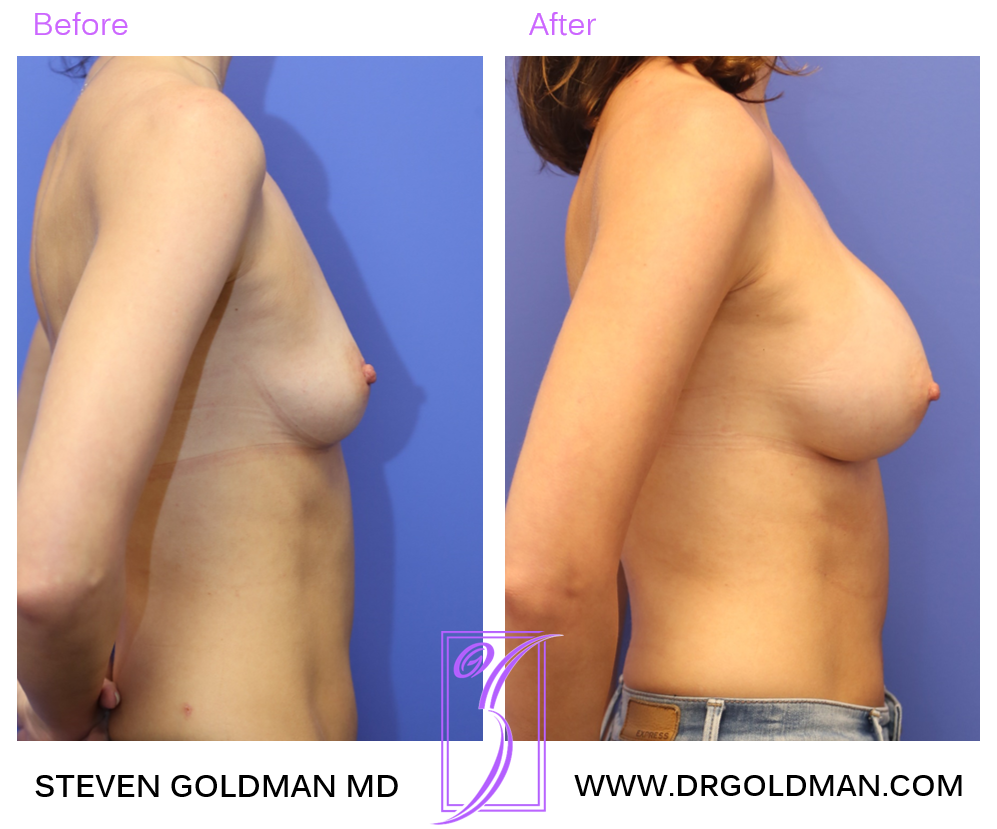 Breast Augmentation