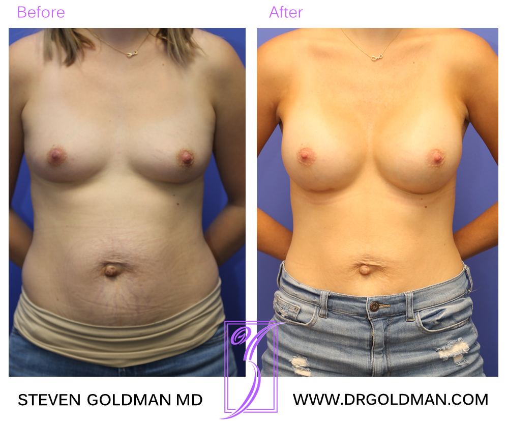 Breast Augmentation