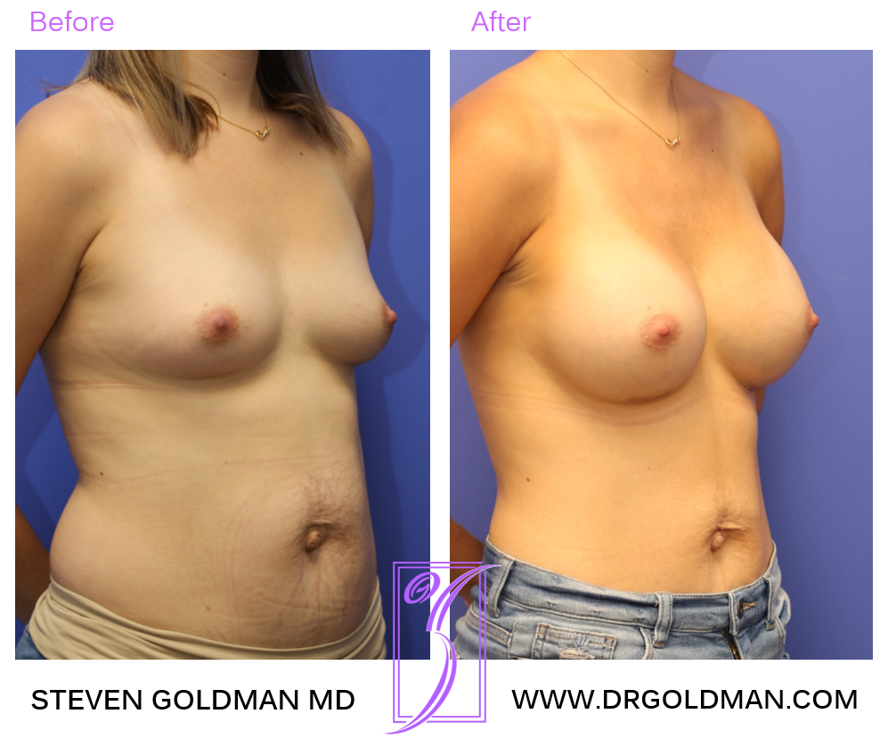 Breast Augmentation