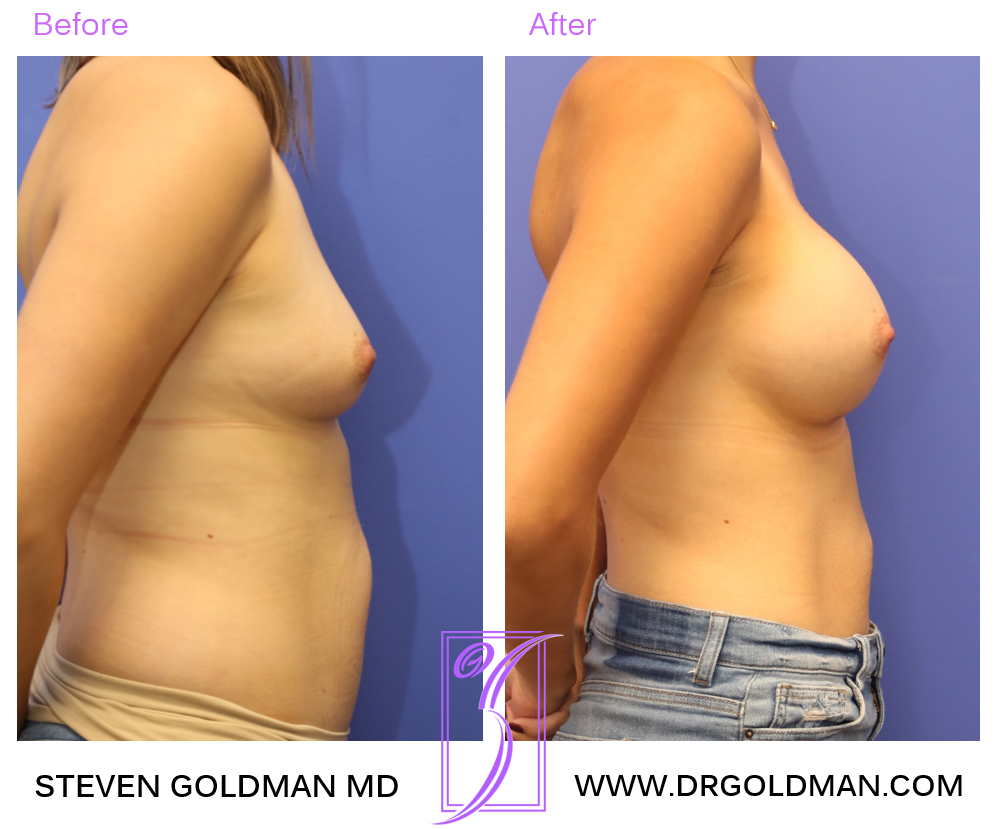 Breast Augmentation