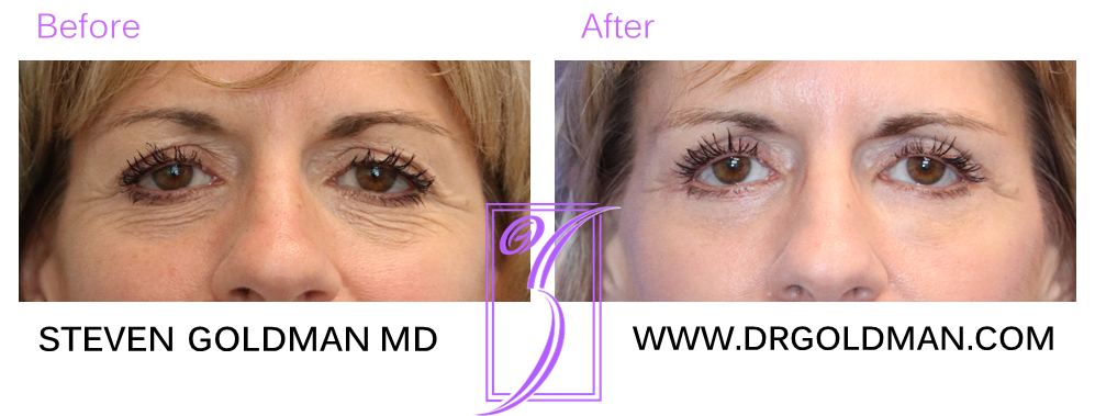 Blepharoplasty