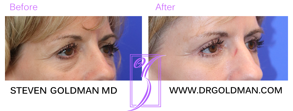 Blepharoplasty