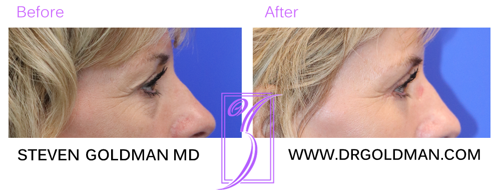 Blepharoplasty