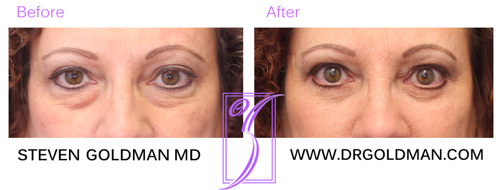 Blepharoplasty