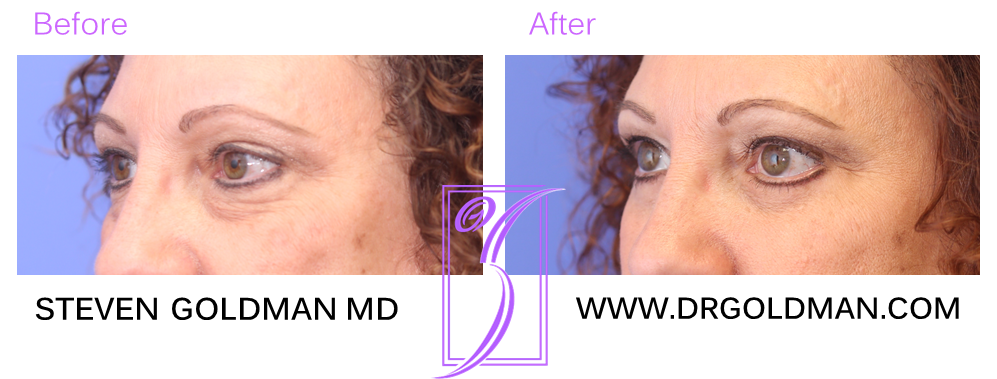 Blepharoplasty