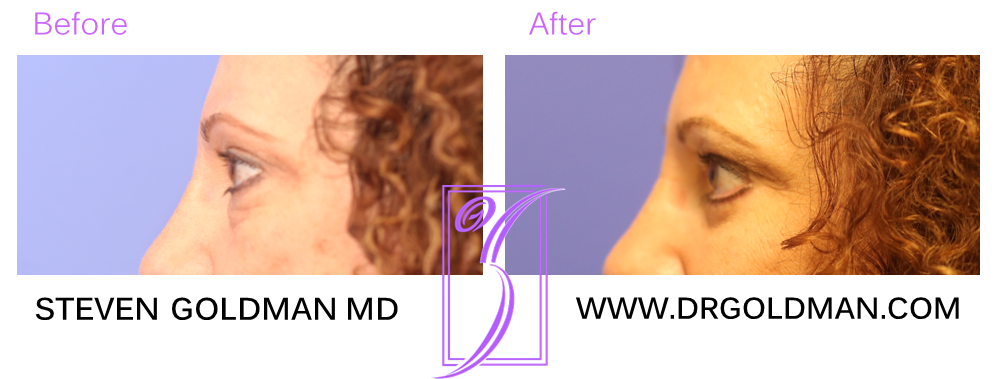 Blepharoplasty