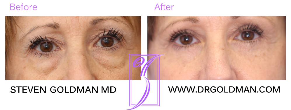 Blepharoplasty