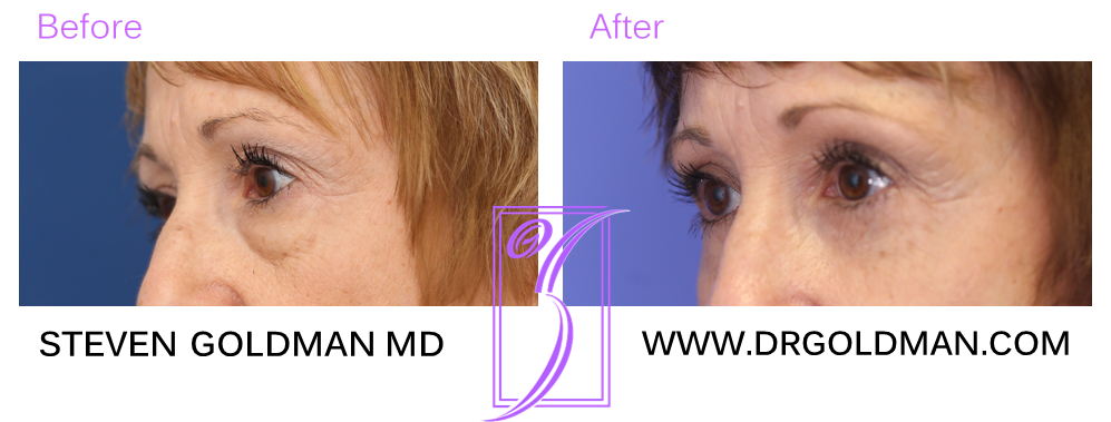 Blepharoplasty