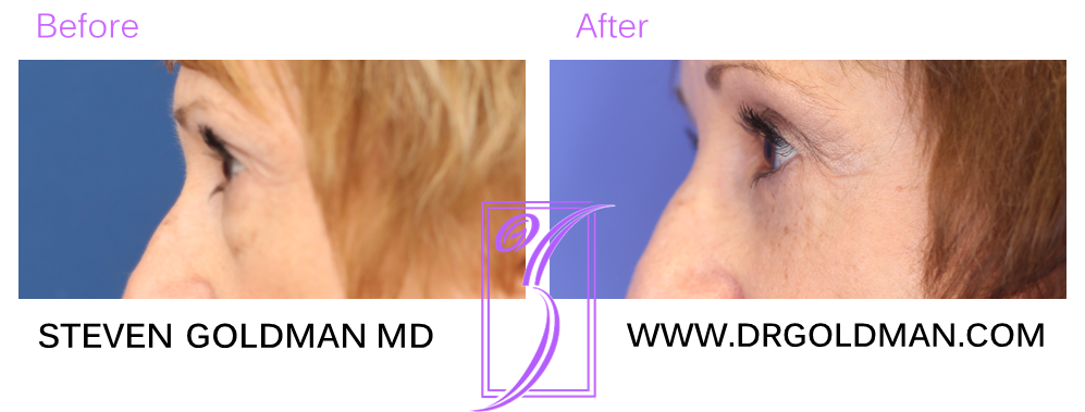 Blepharoplasty