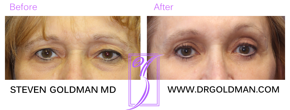 Blepharoplasty