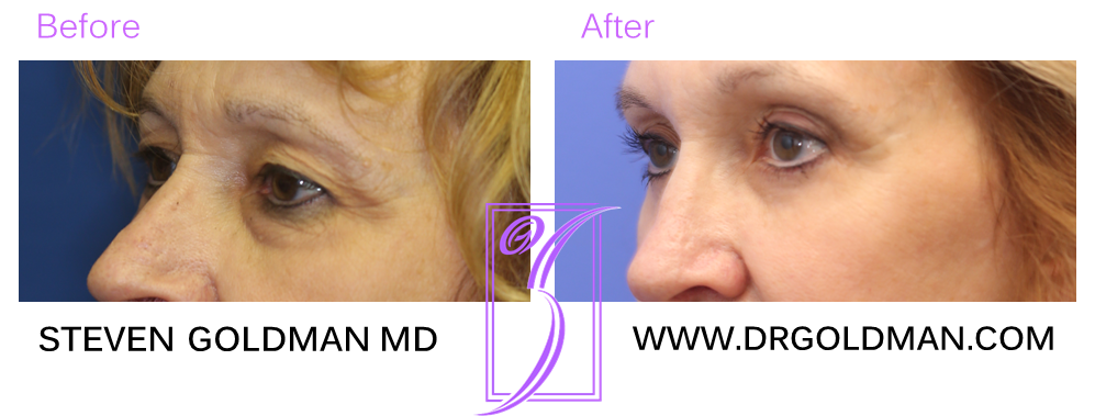 Blepharoplasty