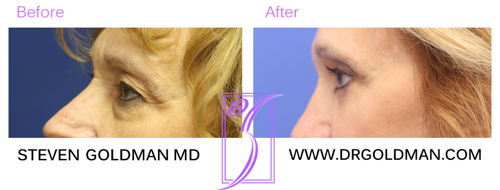 Blepharoplasty