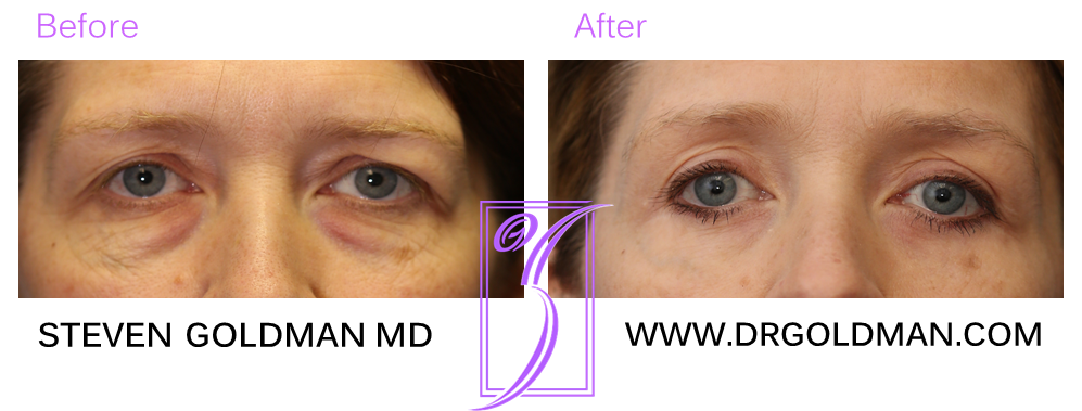 Blepharoplasty