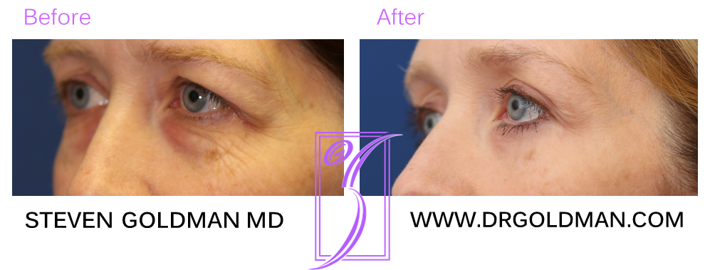 Blepharoplasty