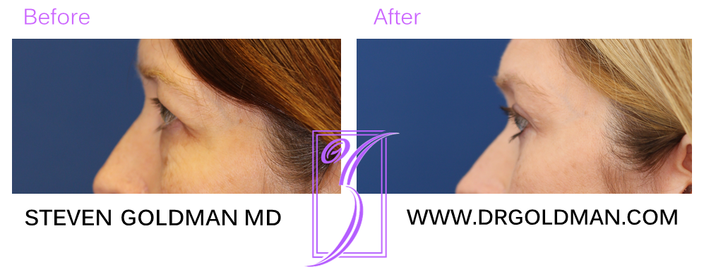 Blepharoplasty