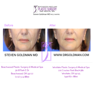 Face Lift vs Neck Lift